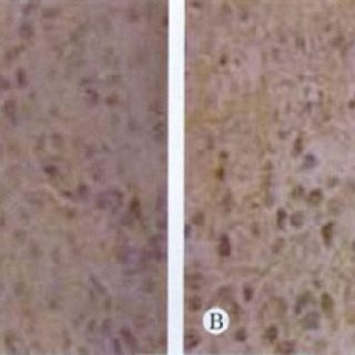 图1肝癌细胞Caspase-3蛋白的表达(DABx400). A：阴性对照组；R：AC 40 mg/kg组