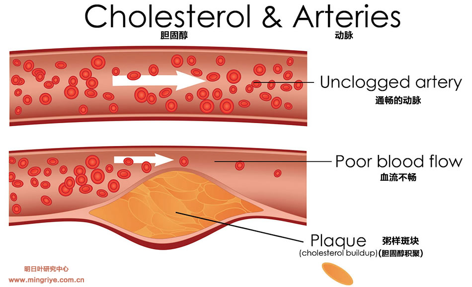 高胆固醇与动脉 cholesterol-Levels-arteries