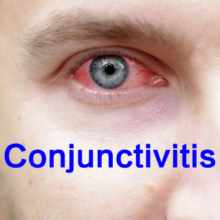 结膜炎