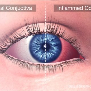 正常的结膜与发炎的结膜